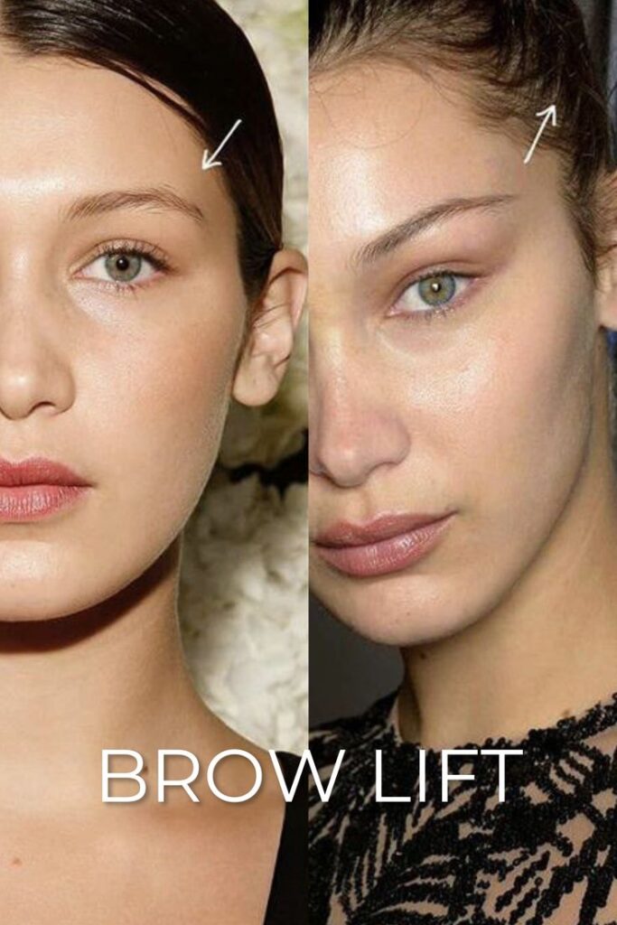 Eyebrow Lifting in Abu Dhabi